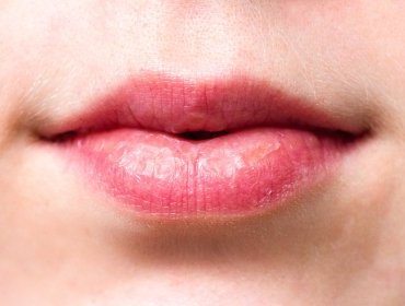 Labbra secche e screpolate? Ecco i migliori rimedi fai da te